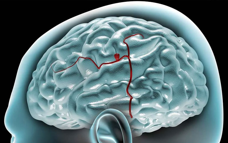 México registra cerca de 7 mil 800 casos de ruptura de aneurisma cerebral al año
